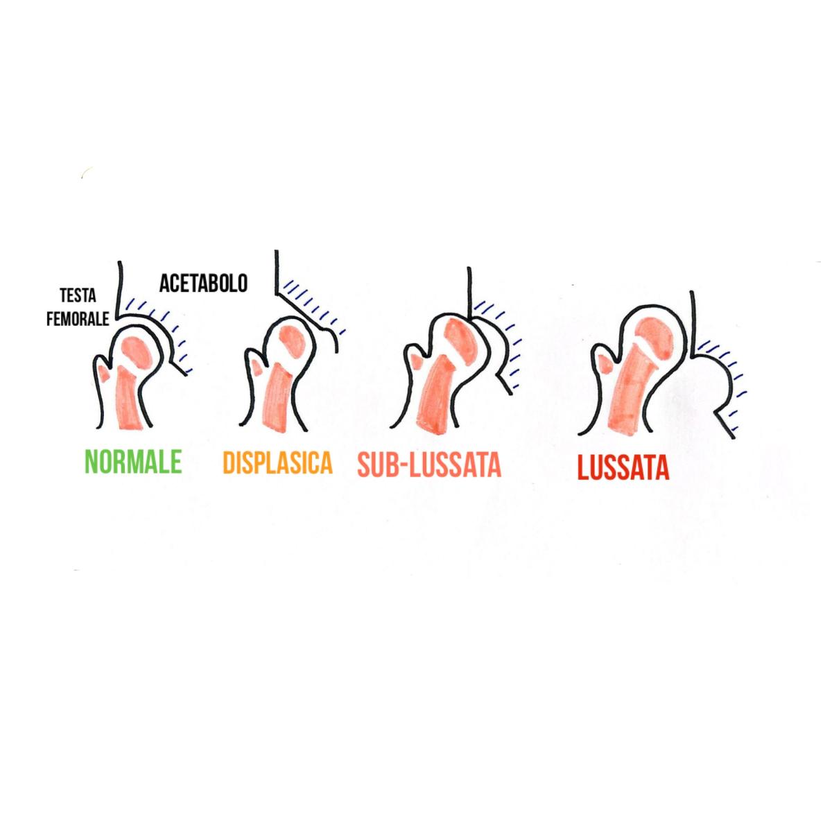Displasia evolutiva dell’anca (DEA)
